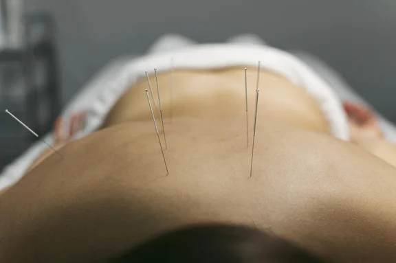 Eine Frau liegt mit Akupunkturnadeln auf ihrem Rücken, bereit für eine wohltuende Therapie.