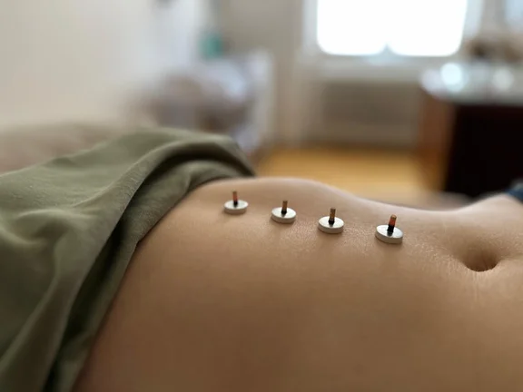 Nahaufnahme des Bauchs einer liegenden Person mit vier Moxibustion-Kegeln auf weißen runden Halterungen, aufgereiht nebeneinander auf der Haut. Die Person trägt ein grünes Shirt, das hochgeschoben ist. Im unscharfen Hintergrund ist der Praxisraum mit Holzboden und einem Holzschrank erkennbar.